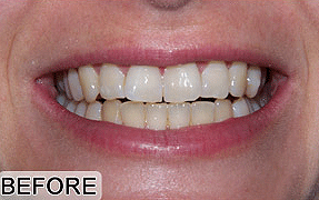 teeth whitening hamilton - before treatment