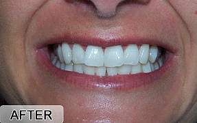 teeth whitening hamilton - after treatment